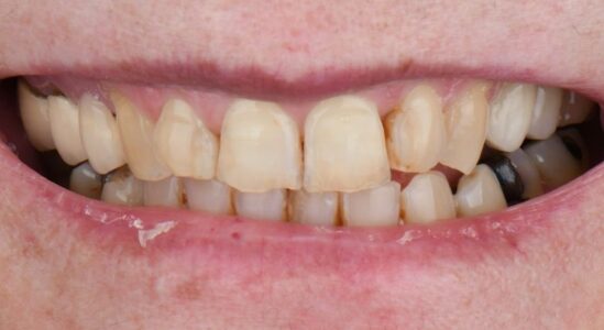 ortodoncia invisible carillas dentales blanqueamiento algemesi valencia sueca carcaixent alzira cullera españa
